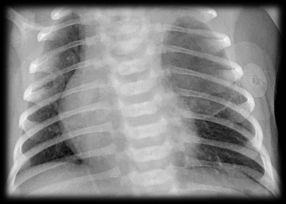 POST-NATAL CHEST RADIOGRAPH Generally, the first line modality after birth Confirms the presence of an abnormality Exception- certain non-mass-like vascular lesions Do