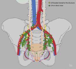 Lymph Node Drainage of the Bladder Extended PLND resected 92% of all primary
