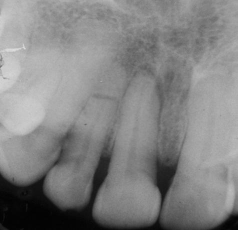 Treatment plan comprised of reduction, semirigid splinting and endodontic treatment of only the coronal fragment in relation to 12, as the fracture fragments were not approximated and the possibility