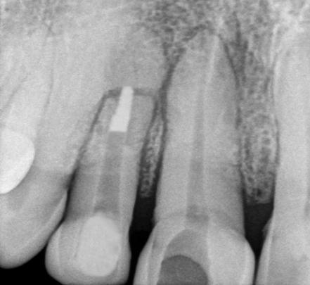 A required length of fiber material that was preimpregnated with bonding agent was cut and placed in the access cavity with its two ends extending on buccal and lingual walls of root.