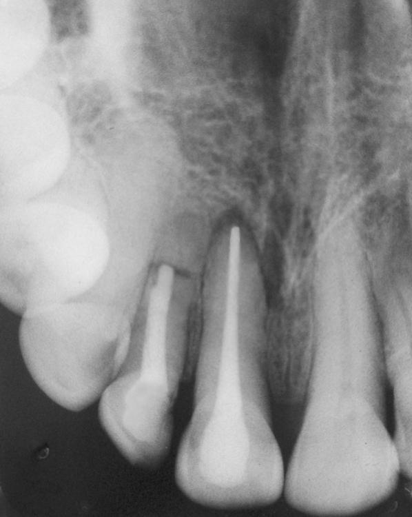 Splint was removed after 2 week & mobility was within normal limits. At recall visits teeth were asymptomatic and responded normally to palpation and percussion.