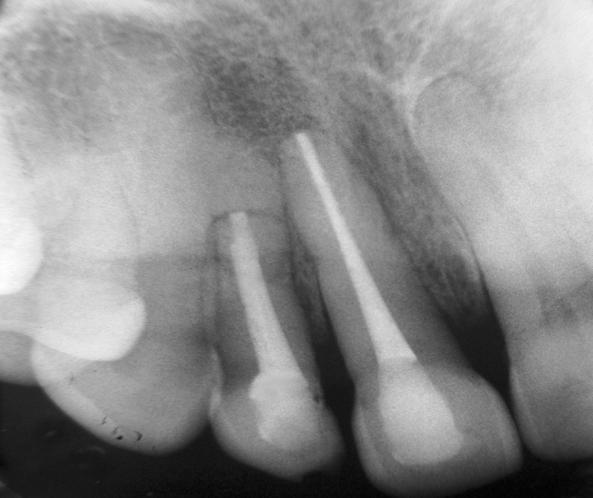 The apical fragment remains essentially uninjured. To facilitate healing, optimal repositioning and stabilization of teeth is considered essential [1].