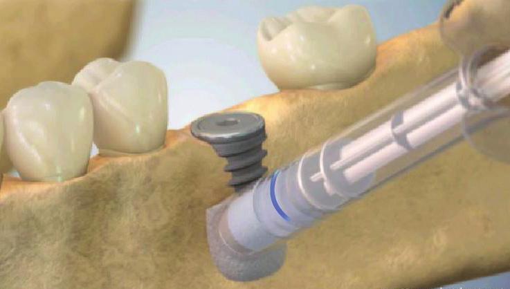 Dehiscence and Fenestrations The cement should be placed above the bone and the exposed threads of the new placed implant or above the exposed root after scaling and root planning.
