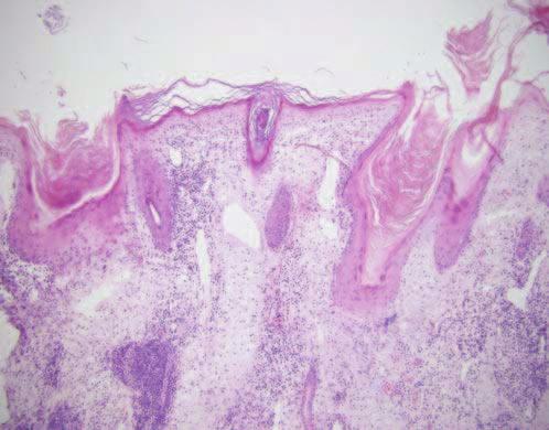 thinned epidermis with superficial and deep dermal inflammation LOW 6-37