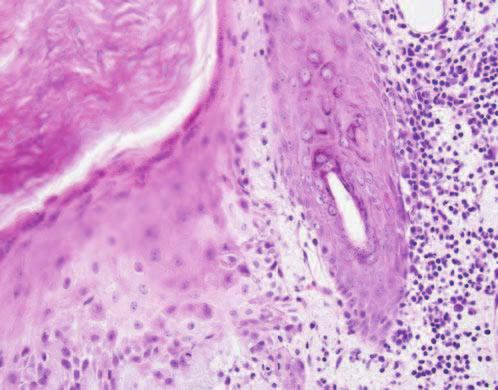 Telangiectasia MEDIUM 6-38 Interface dermatitis Ragged basilar epidermis