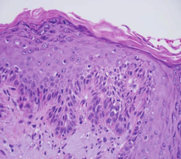 confined to the basilar area of the epithelium MEDIUM 6-1 Parakeratosis Normal Keratinocytes
