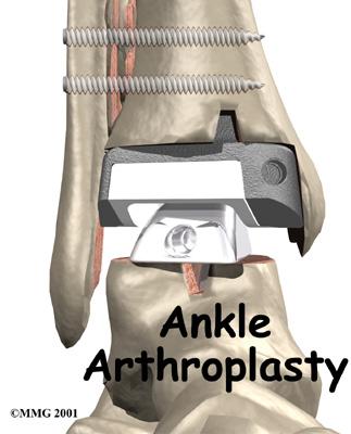 Introduction Surgery to replace the ankle joint with an artificial joint (called ankle arthroplasty) is becoming more common.