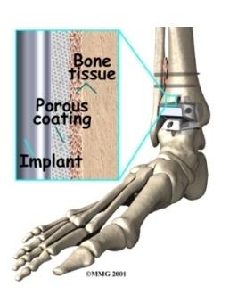 This is called an uncemented prosthesis. The surface of this type of prosthesis bears a fine mesh of holes that allow bone to grow into the mesh and attach the prosthesis to the bone.