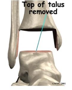 The surgeon begins the operation by making an incision through the skin on the front of the ankle. Once through the skin, the nerves and blood vessels are protected and moved to the side.