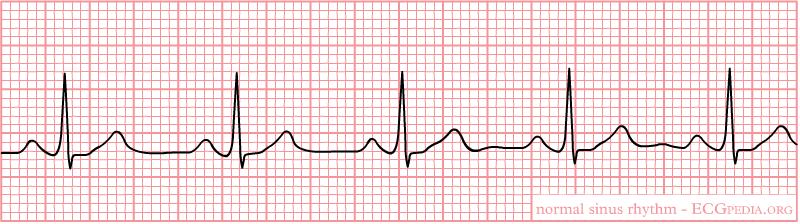 The information is interpreted by a machine and drawn as a graph. The graph consists of multiple waves, which reflect the activity of the heart.