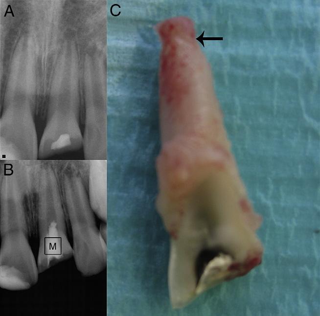 Figure 1. (A) A preoperative radiograph of tooth #9. (B) A radiograph of the fractured tooth 3.5 weeks after revascularization. (C) A photograph of the extracted tooth.
