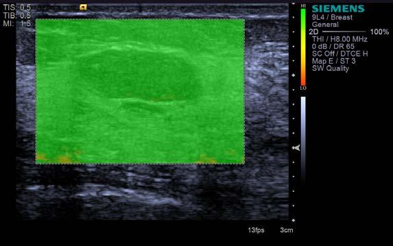 Virtual Touch IQ* Next Generation Strain Imaging Characterize tissue stiffness. Breast Fibroadenoma Velocity Mode Courtesy of Dr.