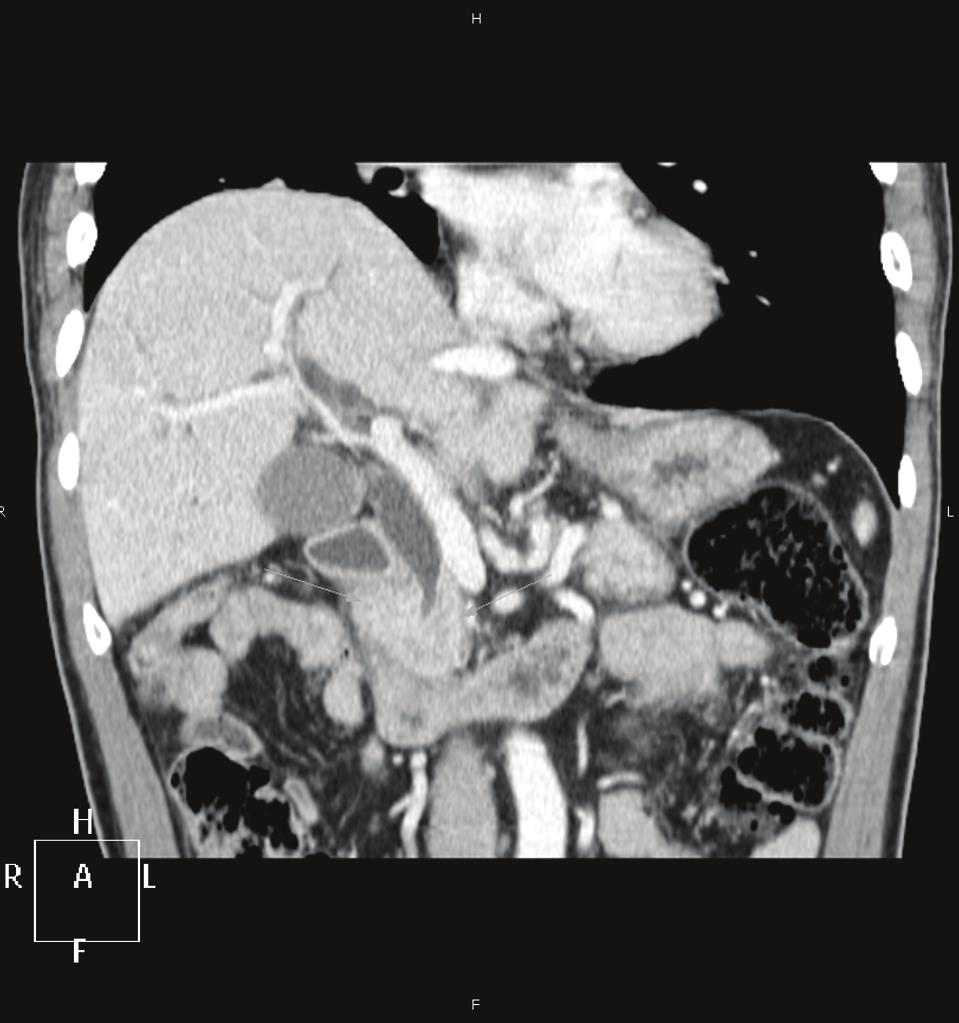 57 taneously recurrent migratory venous thrombosis, arterial thrombosis, microangiopathy, nonbacterial thrombotic endocarditis, or acute or chronic disseminated intravascular coagulation [3].