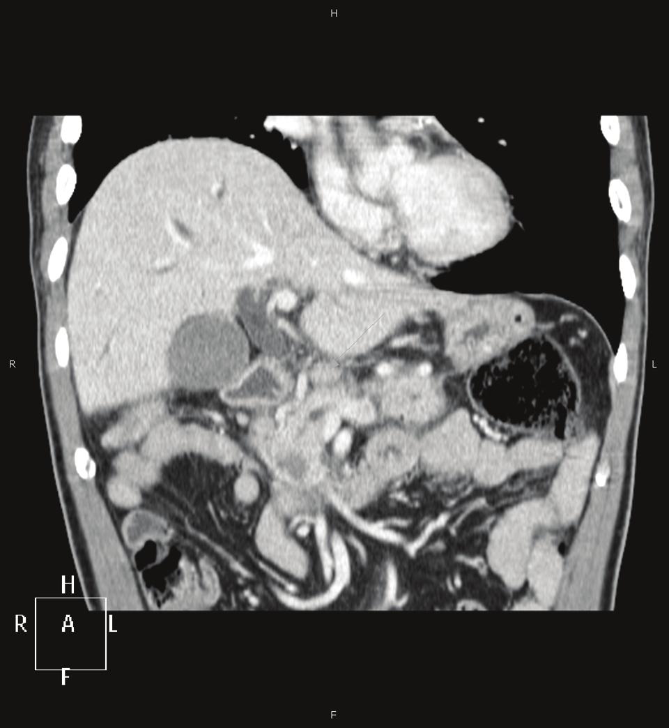 cancer [4,5]. Here we have presented an interesting case of Trousseau's syndrome associated with pancreatic adenocarcinoma.