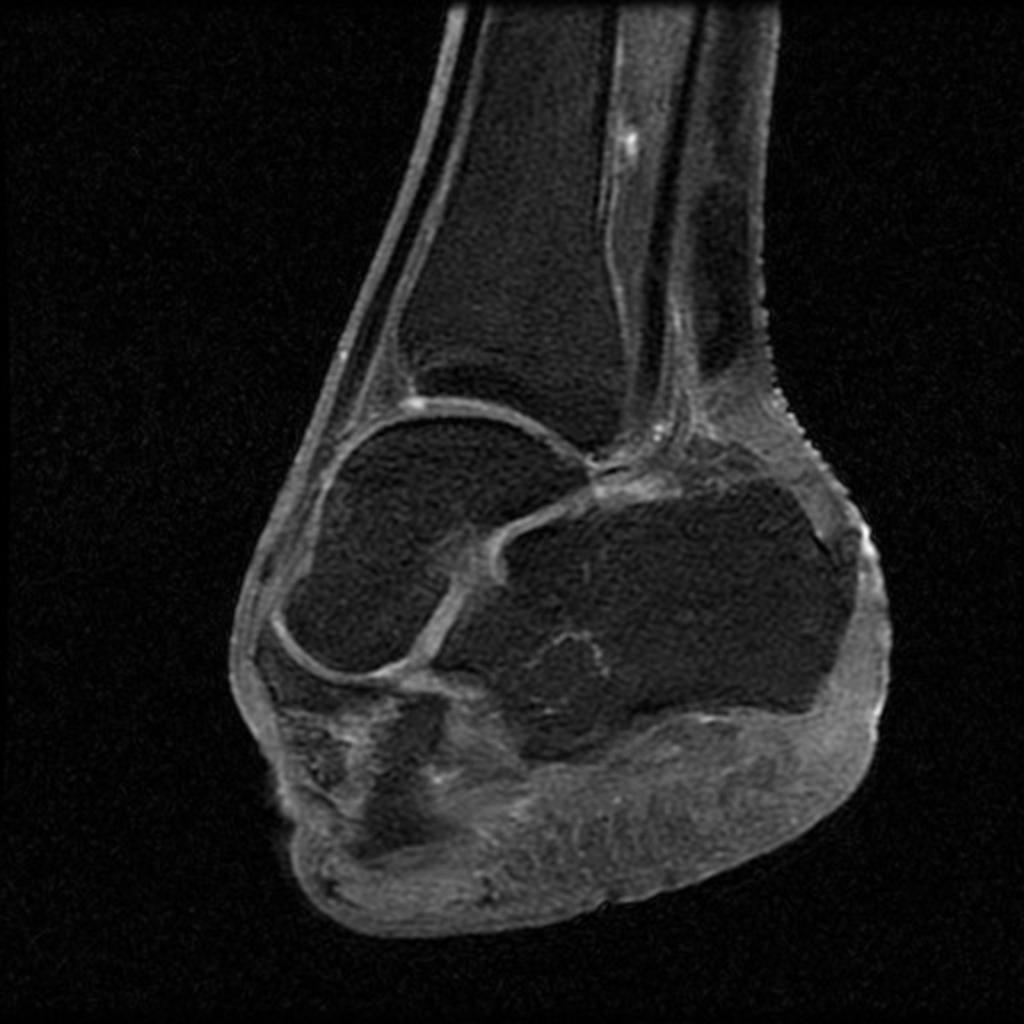 Fig. 36: Ray amputation of 5th metatarsal bone with mild osteitis. Fig.