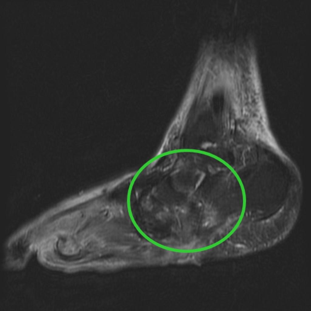 hyperintensity in the midfoot. Fig.