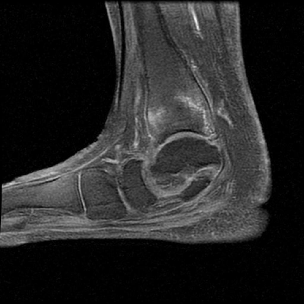 35 Singapore Periarticular erosions in the mid foot due to