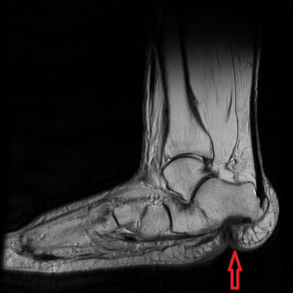 Commonly at 1, 5th toes, MTP and calcaneus ulcerations at pressure