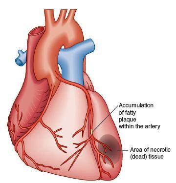 A heart attack or myocardial infarction (my-oh- KAR-dee-al-In-FARK-shun) is a blockage in the
