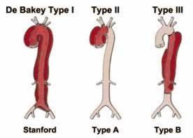 Type A Aortic Dissection Epidemiology:!
