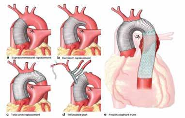 With/without aortic valve!