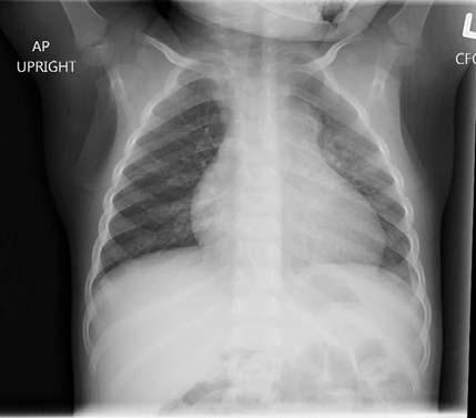CXR Specimens for Culture Expectorated sputum Induced sputum can be done in young children with RT expertise Gastric aspirate (preferred