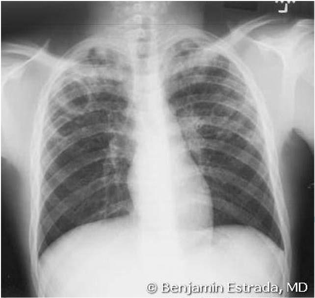 Childhood TB - Various X ray Presentations: Adult type pulmonary disease 15 yo boy UNUSUAL for children (but AAP RedBook 2012 CXR Nonspecific, intra-observer variation