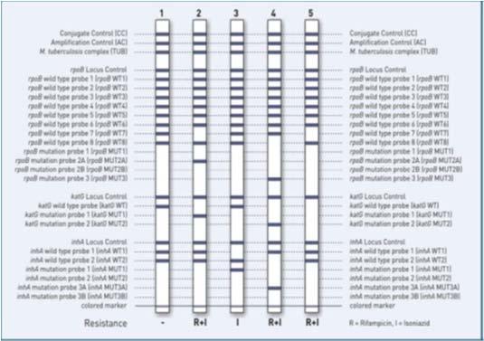 NUCLEIC ACID AMPLIFICATION TESTS: LINE PROBE ASSAY Genotype MTBDrPlus (Hain lifescience): Line probe assay for detection of first line drug resistance (MDR TB) rifampicin resistance rpob gene high