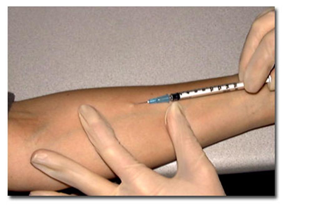 Method of Tuberculin Skin Test Mantoux test: Ø Intradermal inoculation of 0.