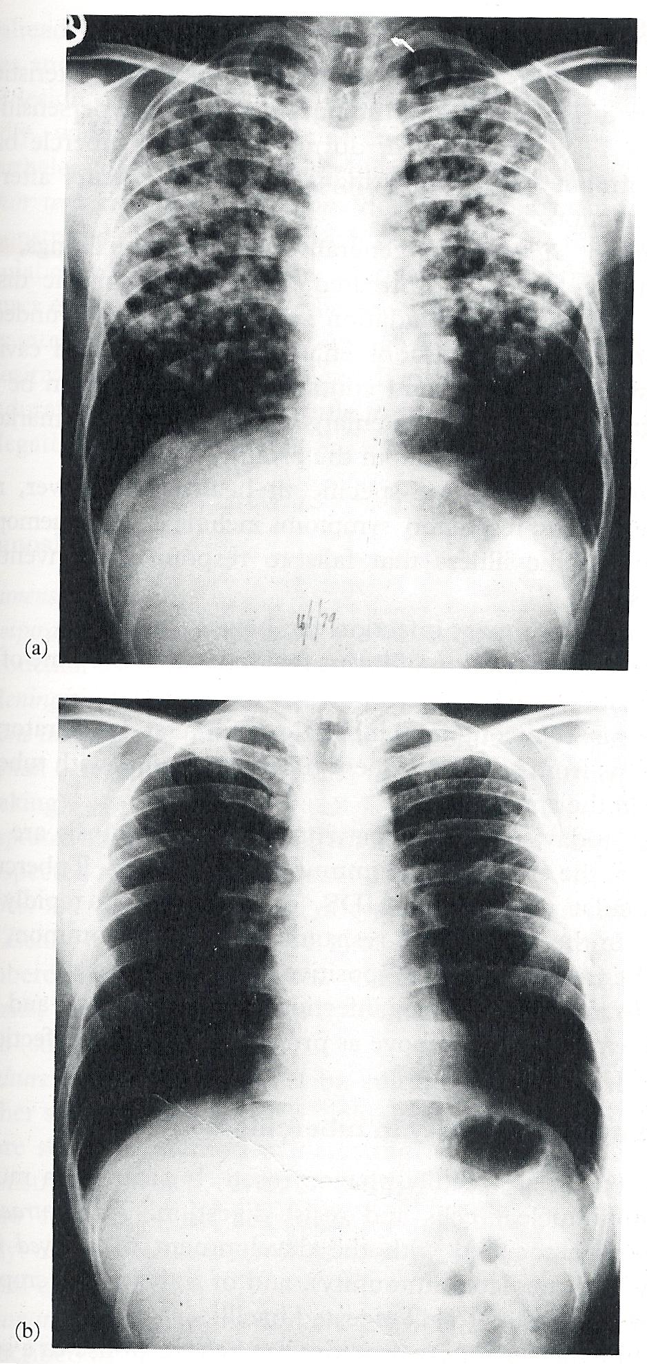 Tuberculosis: (a) Chest X-ray of a patient with tuberculosis bronchopneumonia.