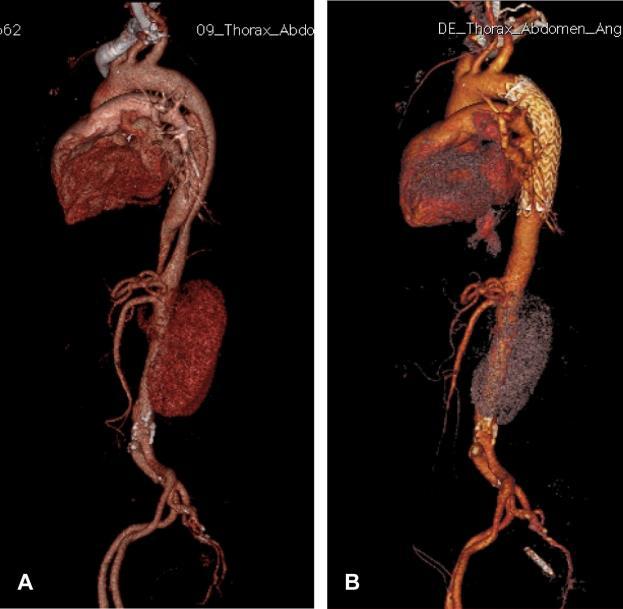 Aortic Remodeling after TEVAR for Type B Aortic Dissection Aortic Remodeling in Acute Uncomplicated Type B Dissections