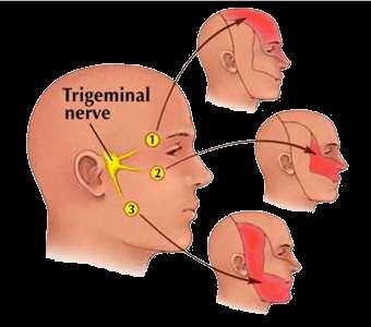 Migraine (V1 activation)