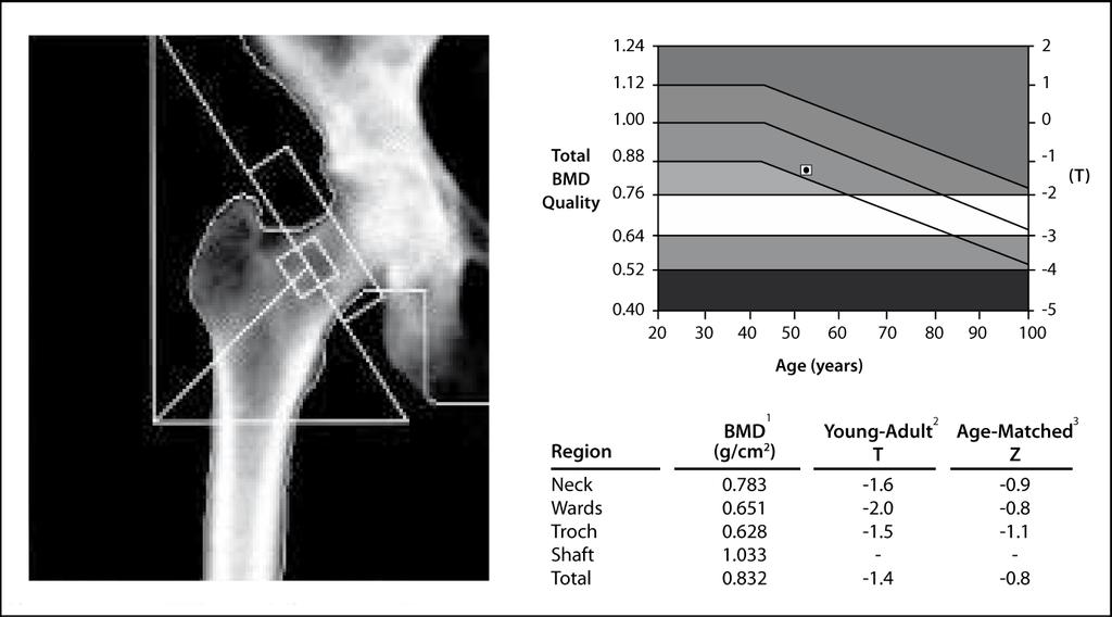 skeletal status. Quantitative ultrasound (QUS) measurement of the heel is perhaps the most promising technique. Bone ultrasound devices use frequencies in the range of 0.2-1.
