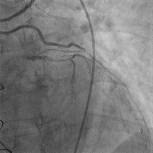 stenosis; Figure D Right coronary artery with