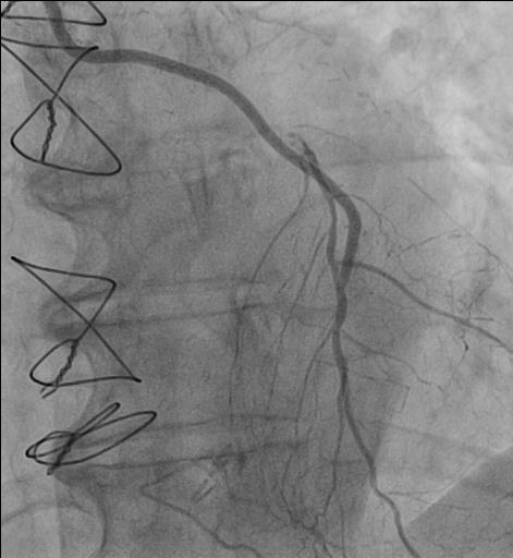 result of previous PCI on the anastomosis of RIMA to LAD.