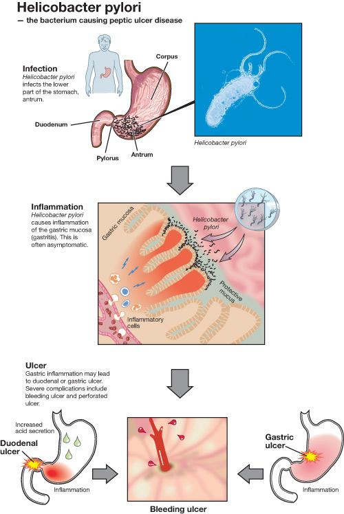 Peptic Ulcer Disease Gastroduodenal ulcer disease remains a common cause of UGI bleeding. There are four major risk factors for bleeding peptic ulcers: 1. Helicobacter pylori infection 2.