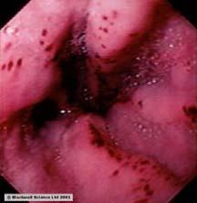 However, elderly patients with a prior history of bleeding ulcer disease are at increased risk for recurrent ulcer and complications.