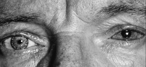 Age-related lens modifications Épaisseur (mm)! Presbyopia! Risk of acute angle closure glaucoma!