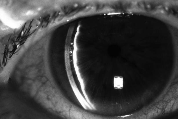 red eye half-mydriasis corneal oedema   red eye