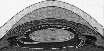 cataract (section view)