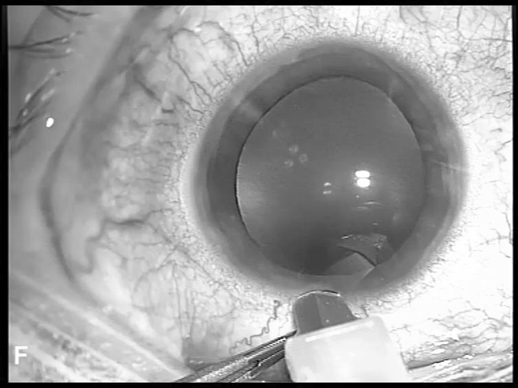 Current cataract surgery