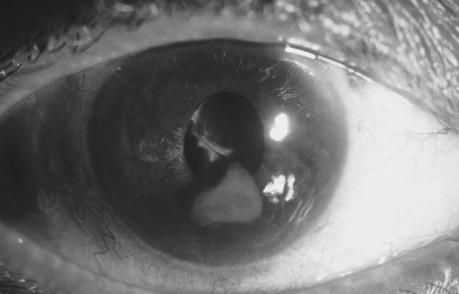 Current cataract surgery