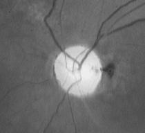 Cataract surgery bad visual prognosis 2. Optic nerve pathology Chronic glaucoma Optic neuropathy Ischemic Horton s disease TREATMENT?