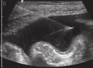 1.4 Interventional Ultrasound 13 Fig. 1.11. Free-hand puncture of ascites.