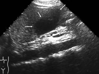1.4 Interventional Ultrasound 15 The success of the treatment is controlled with ultrasound over the next few days.