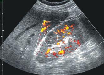 1.2 Imaging Techniques 7 Fig. 1.10. Power-Doppler image of the right kidney. This technique is more sensitive.