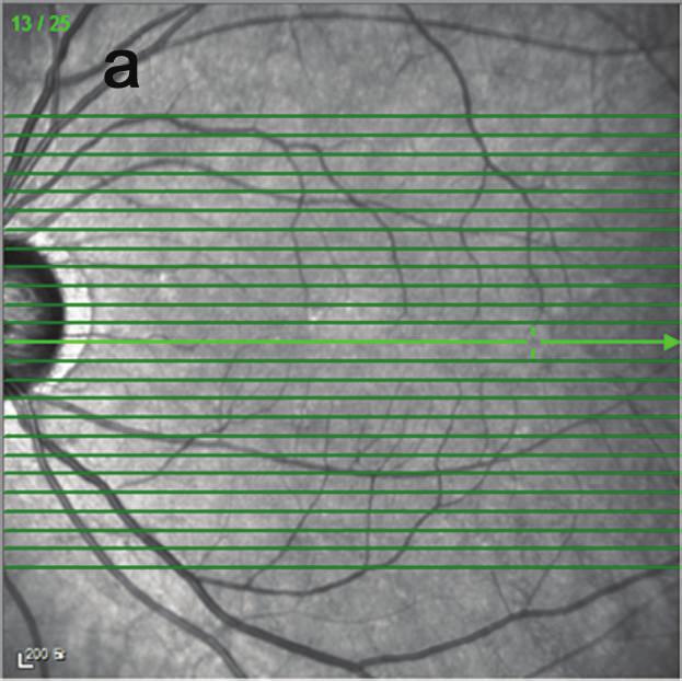 2 Journal of Ophthalmology 8 7 6 5 4 3 2 1 Retina thickness (μm) Volume [mm? 5.66 Average thickness (μm) 164.87.32 25 198 1.5 234.37 227.18 221.35 192 1.2 236.37 216 1.