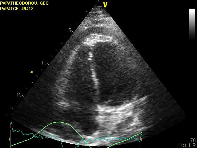 Similar Respiratory variation in mitral flow Acute dilatation of the heart