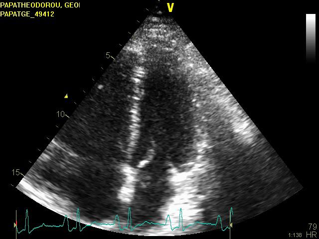 patterns of Constriction Effusive-constrictive pericarditis Transient Occult