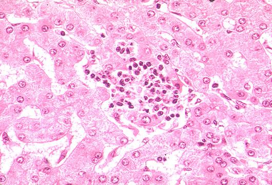 2 Glandular epithelial cells regeneration liver Spotty necrosis--the